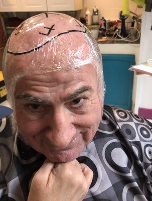 Hair replacement in the works!