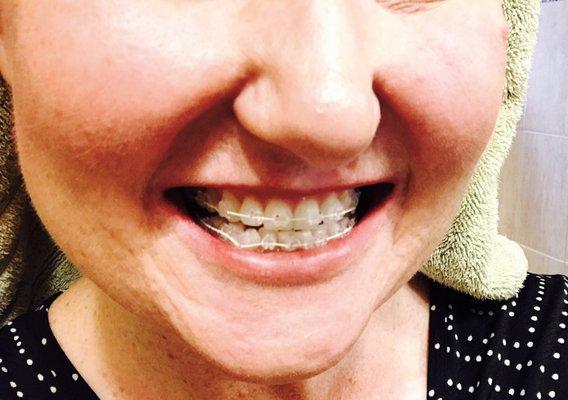 Clear Braces unless I show people No one knows I have them on