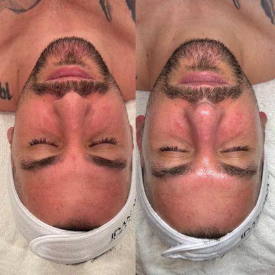 Before and after Salmon DNA facial