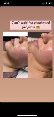 Before and after photos, following daily skin care routine and her recommendations