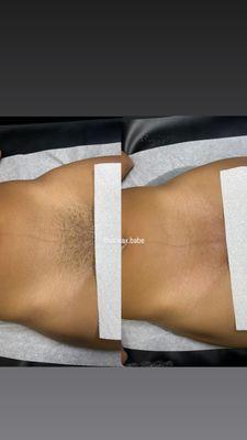 Brazilian Wax Before & After