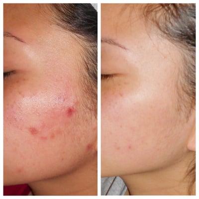 Results of consistent light therapy, microdermabrasion, & at home skin care routine created by Samantha. Be patient!