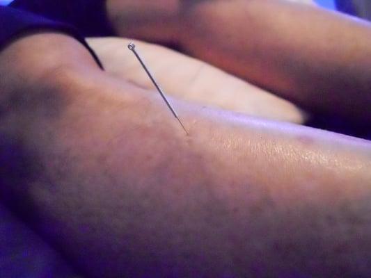 acupuncture needle at ST-36 (Zu San Li); used for fatigue, increasing heart rate, and building up immunity.