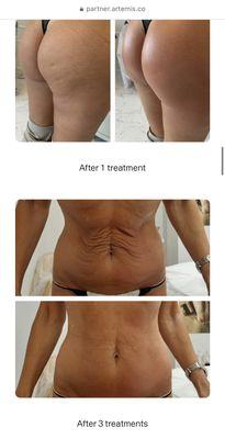 Artemis T2 Anti-Aging, Cellulite, Lifting, Tightening & Shaping Face & Body Treatment