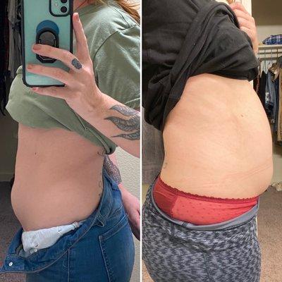 Now vs 3 weeks ago. Notice the significant decrease in bloating