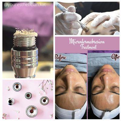 A manual exfoliation that uses a diamond tip to removed dead skin. Great for anti-aging, brightening skin, tightening pores and acne scars.