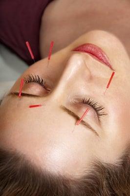 Acupuncture is an excellent choice for facial rejuvenation -- take years off your face!