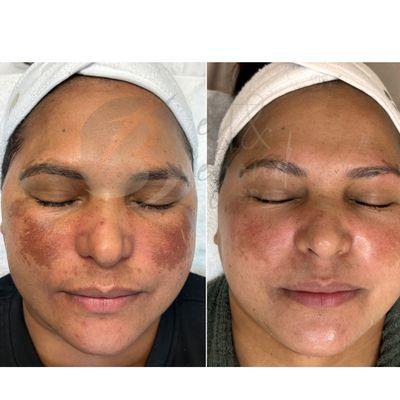 Spots / Melasma treatment