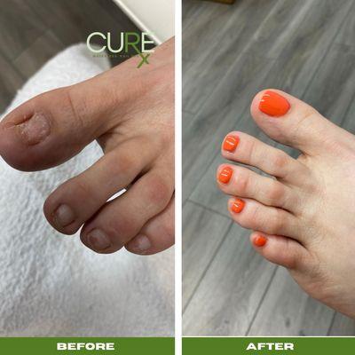 Cure- Wellness pedicure with toenail restoration