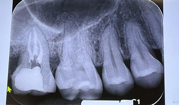 Root canal