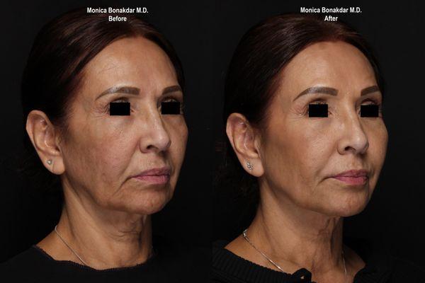 Juvederm Filler for cheeks and lower face.