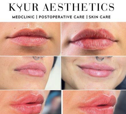 Kyur Aesthetics Non-Surgical BBL Lip Filler