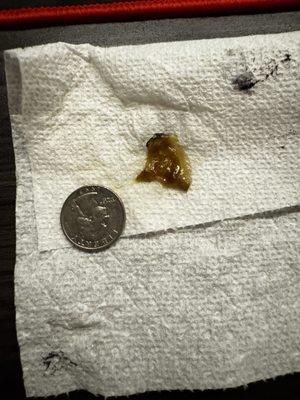 This is what they did to me. Irregular mucus buildup since my surgery but they won't answer any calls.