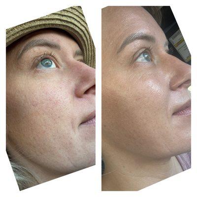 Before and after of my skin. I got the recommended hydration facial.