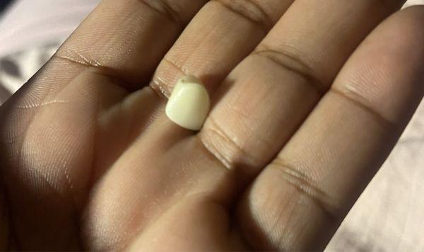 My crown which because of them can't be reinstalled. Now I just have this tooth just here.