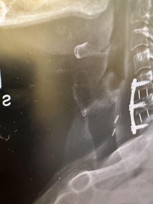 I have placed a platinum device on my neck spinal cord that prevents me lifting too much weight. Resulted in a disability.