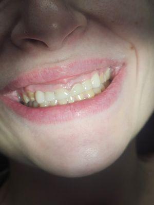 After photo of crowning my 6 front teeth (damage from years of acid reflux and vomiting)
Good person, good dentist!