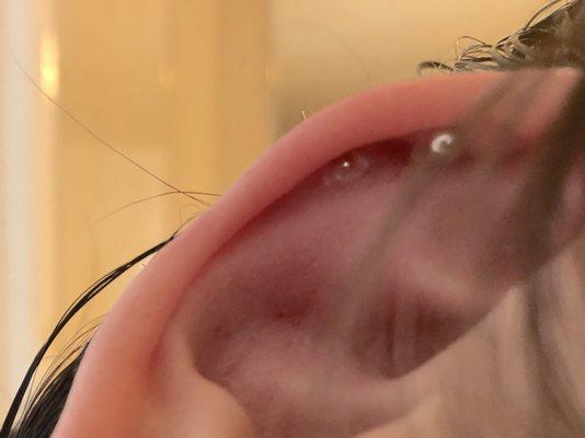 The earring ended up embedded in my ear because of Piercing Pagoda's lack of knowledge and skill.
