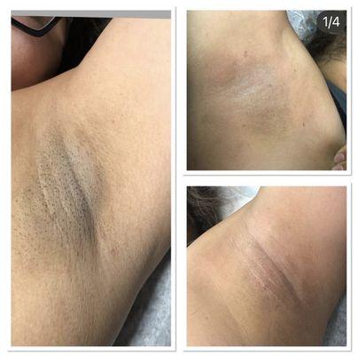 Despigmentation underarms