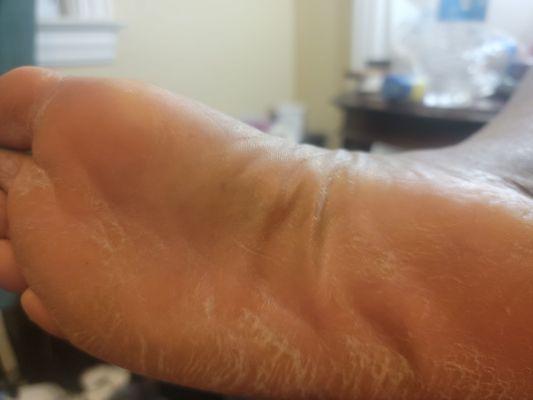 This is the bottom of my foot after the oil had gone away 12/8/22