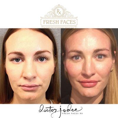 Midface rejuvenation with dermal filler