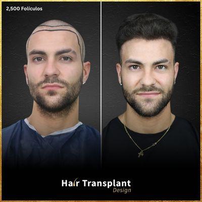 Hair Transplant Design - Tampa