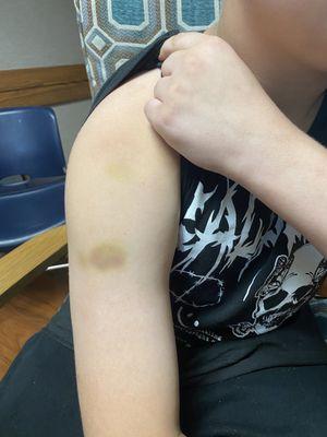 Bruises from staff