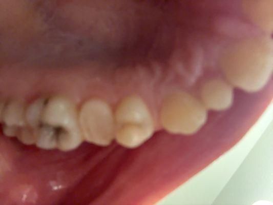 Ah look my "complete" root canal