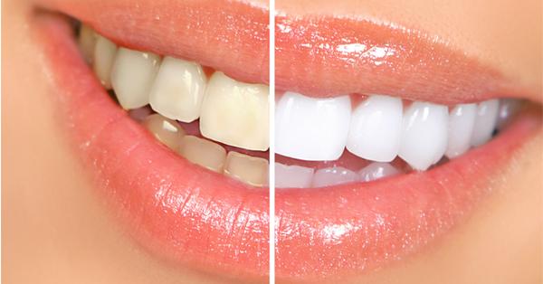 Teeth Whitening