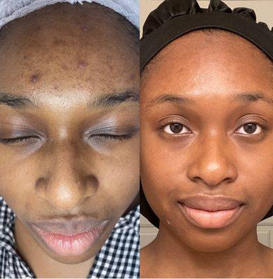6 sessions of chemical peels + recommended homecare