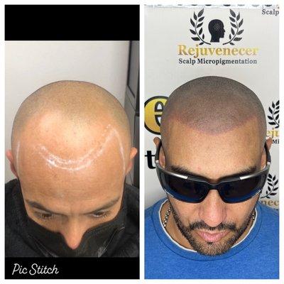 Rejuvenecer Scalp Micropigmentacion