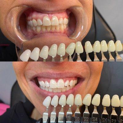 Beautiful 60 minute Express Whitening results with my beautiful clients