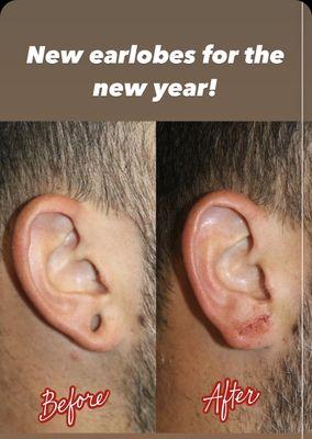 Earlobe repair after gauge earring removal