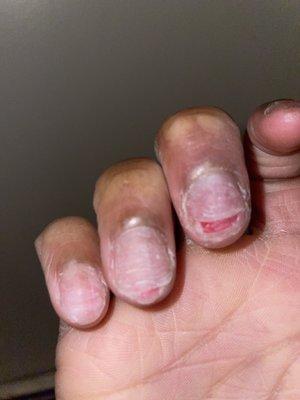 MY BROKEN NAIL BEDS AFTER SERVICING AT TONYS NAILS!!!