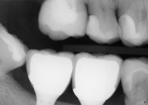 Molar implant crowns