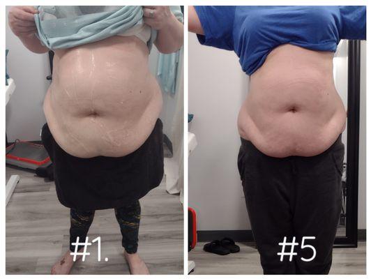 Down 6 inches in 3 weeks!! Cavitation and radio frequency.