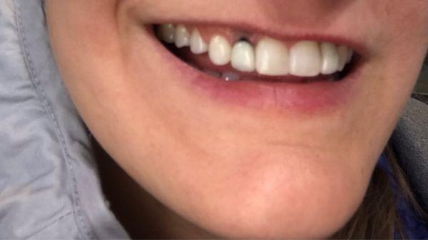 The abutment shows!!