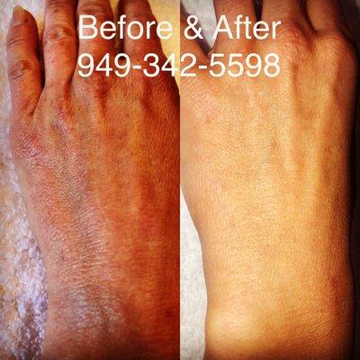Before and After Skin Rejuvenation session. 3 -5 minimum sessions recommended for most.