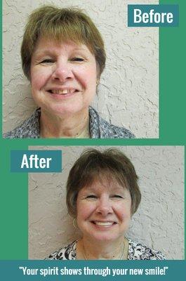 Your spirit shows through your new smile!