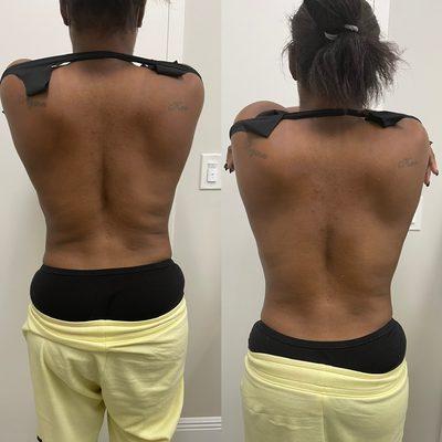 Before and after one session of Ultrasonic Cavitation treatment on back fat.