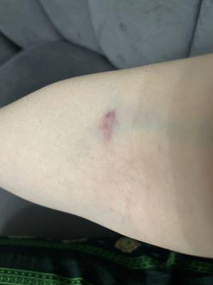 Blood work done today and definitely will get worse tomorrow.