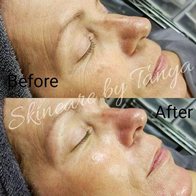 Custom Dermaplaning Infusion Facial