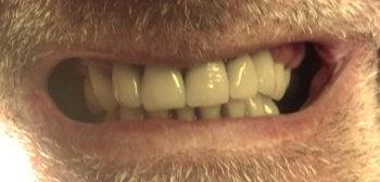 8 crowns and a 'floater' that she and Dr. Daniels created to fill a spot that is not yet ready for an implant.