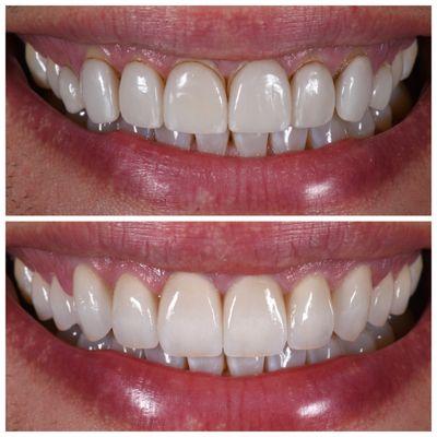 A beautiful veneer revision case-10 super realistic porcelain veneers.