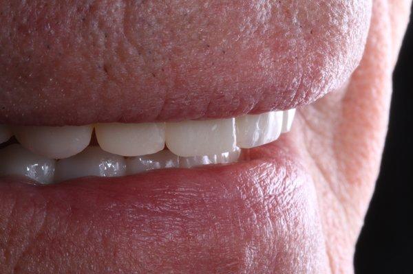 Life like esthetics of the temporaries for a full mouth reconstruction in a physiologic bite position.