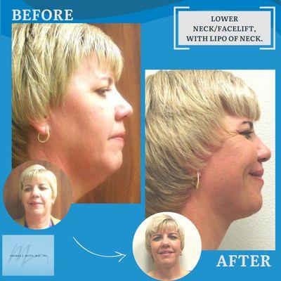 Before & After from Thomas F. Mitts, MD, Inc. | Visalia, CA