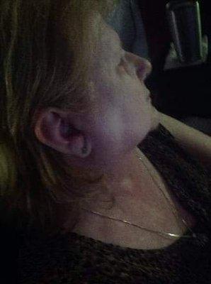 Ear Drum burst and allergic to ear drops