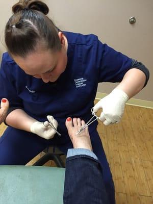 Right foot stitches removal