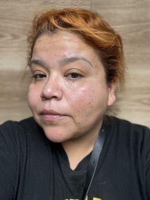 So excited to see the results. Got done a chemical peel and I could already see the results my skin looks so much healthier.