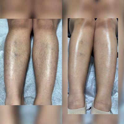 Before/After Leg Wax